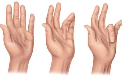Dupuytren’s disease