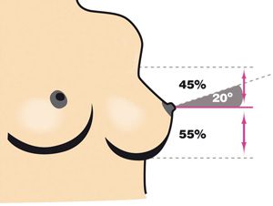 Round or Anatomical Prostheses