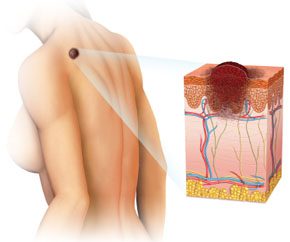 cancer de piel melanoma