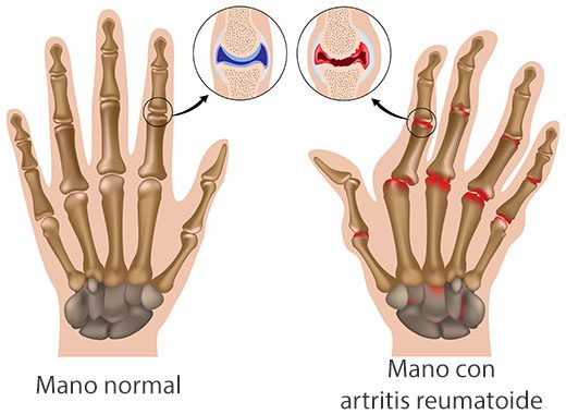 Tratar la artritis reumatoide con Cirugía