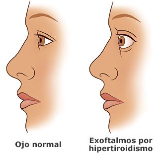 exoftalmos por hipertiroidismo