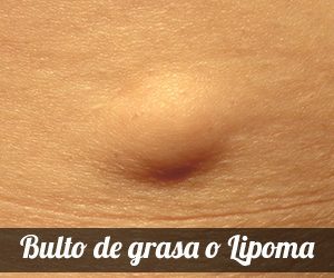 Lipoma, un bulto de grasa bajo la piel