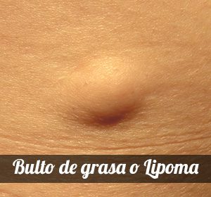 Lipoma, un bulto grasa la piel - Dr. Juan Martínez Gutíerrez