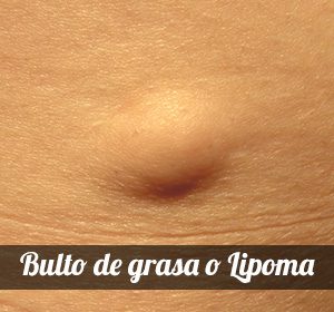 lipoma o bulto de grasa