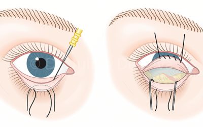 Operación de bolsas de ojos