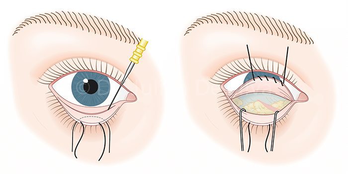Operación de bolsas de ojos