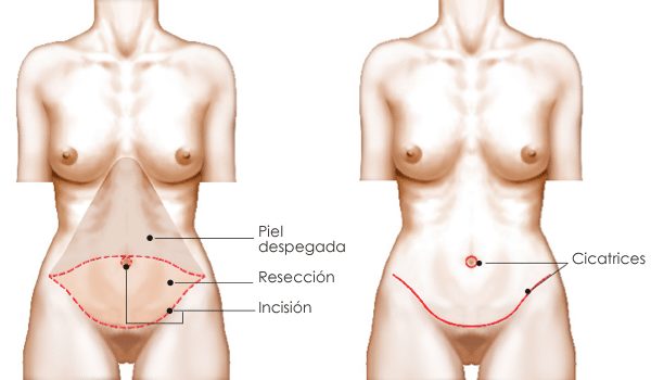 https://www.doctormartinezgutierrez.com/wp-content/uploads/2019/10/abdominoplastia-incisiones-cicatrices-img.jpg