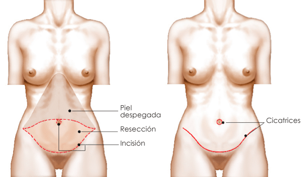 la mejor cirugía para eliminar la grasa del vientre