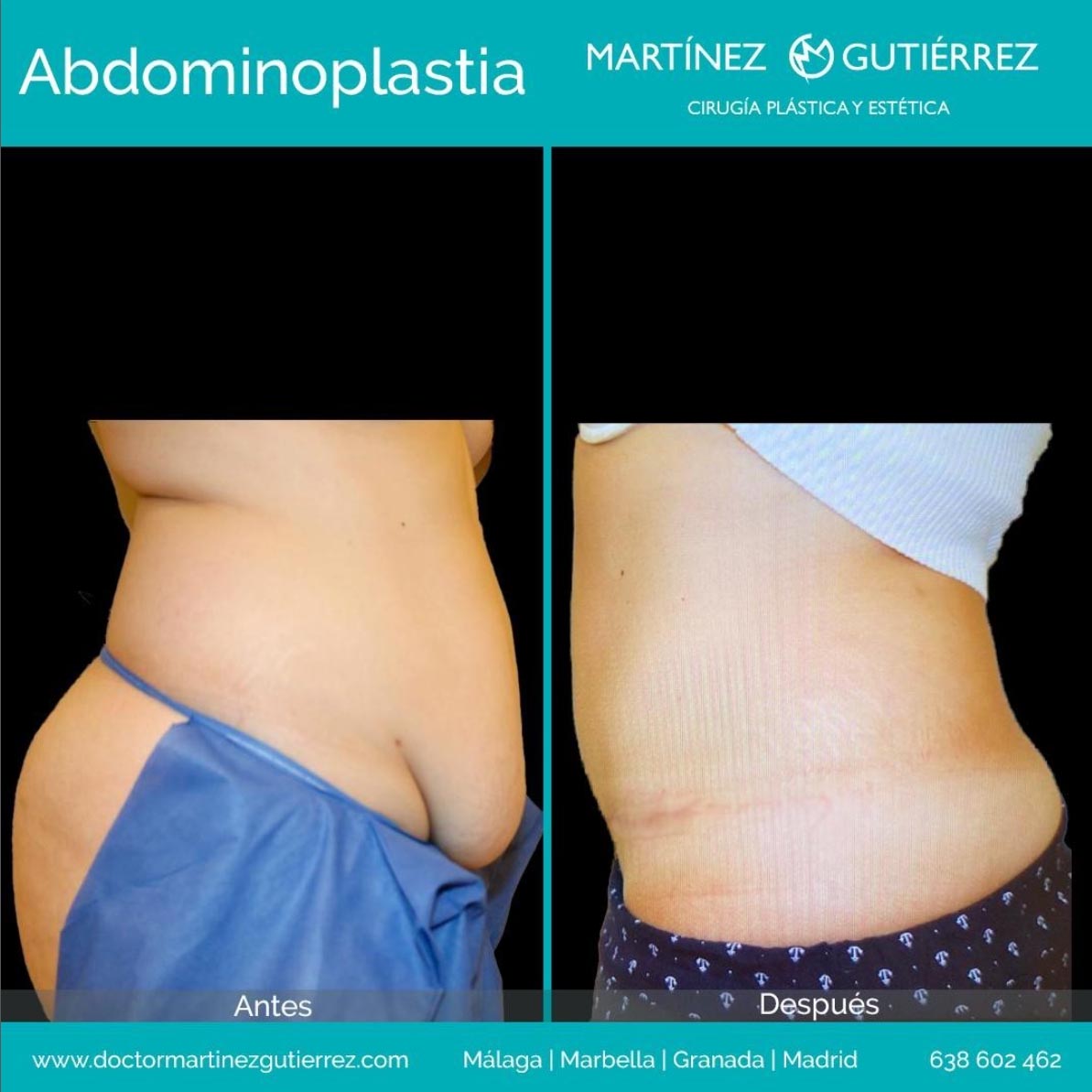 Abdominoplastia resultado1