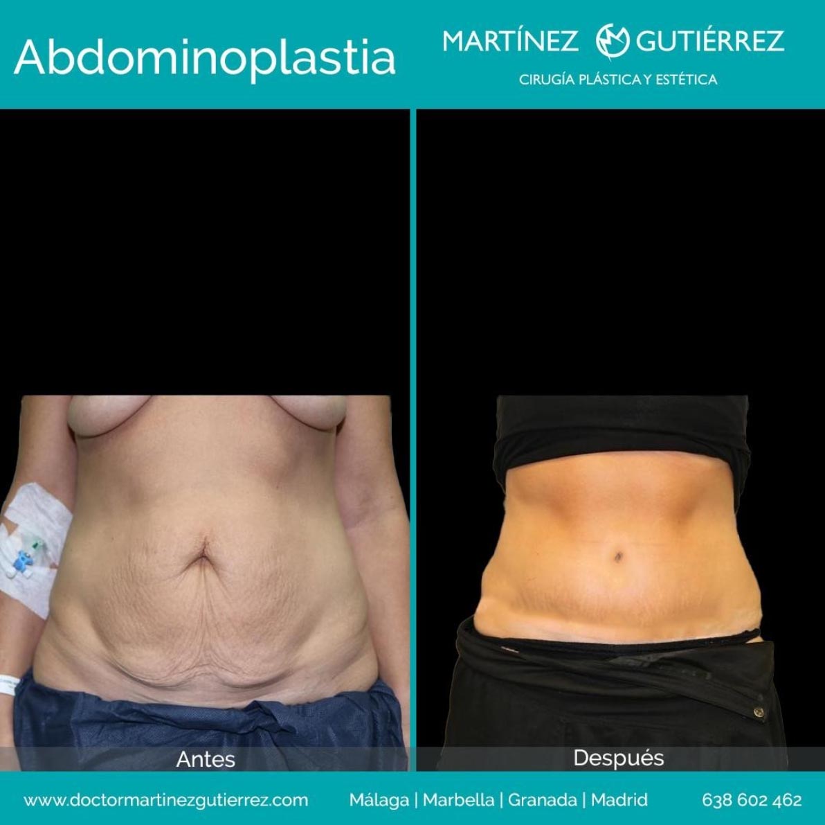 abdominoplastia-resultado2