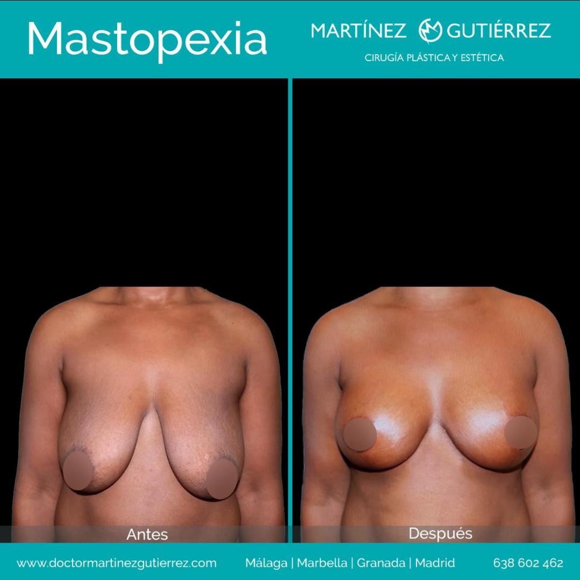 Mastopexia resultado2