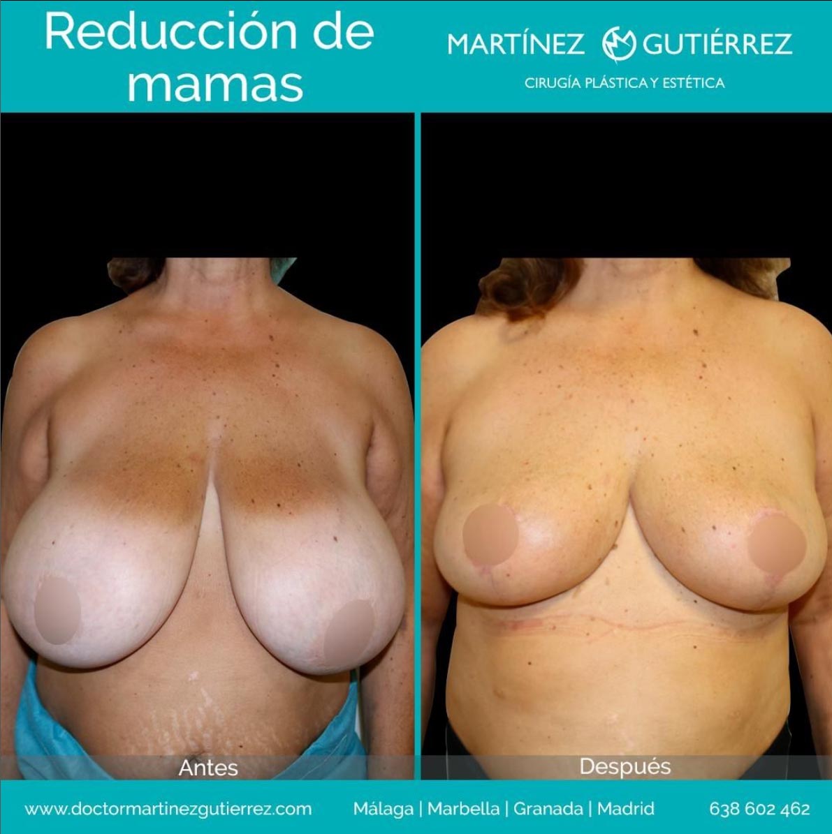 Reducción mamas resultado1
