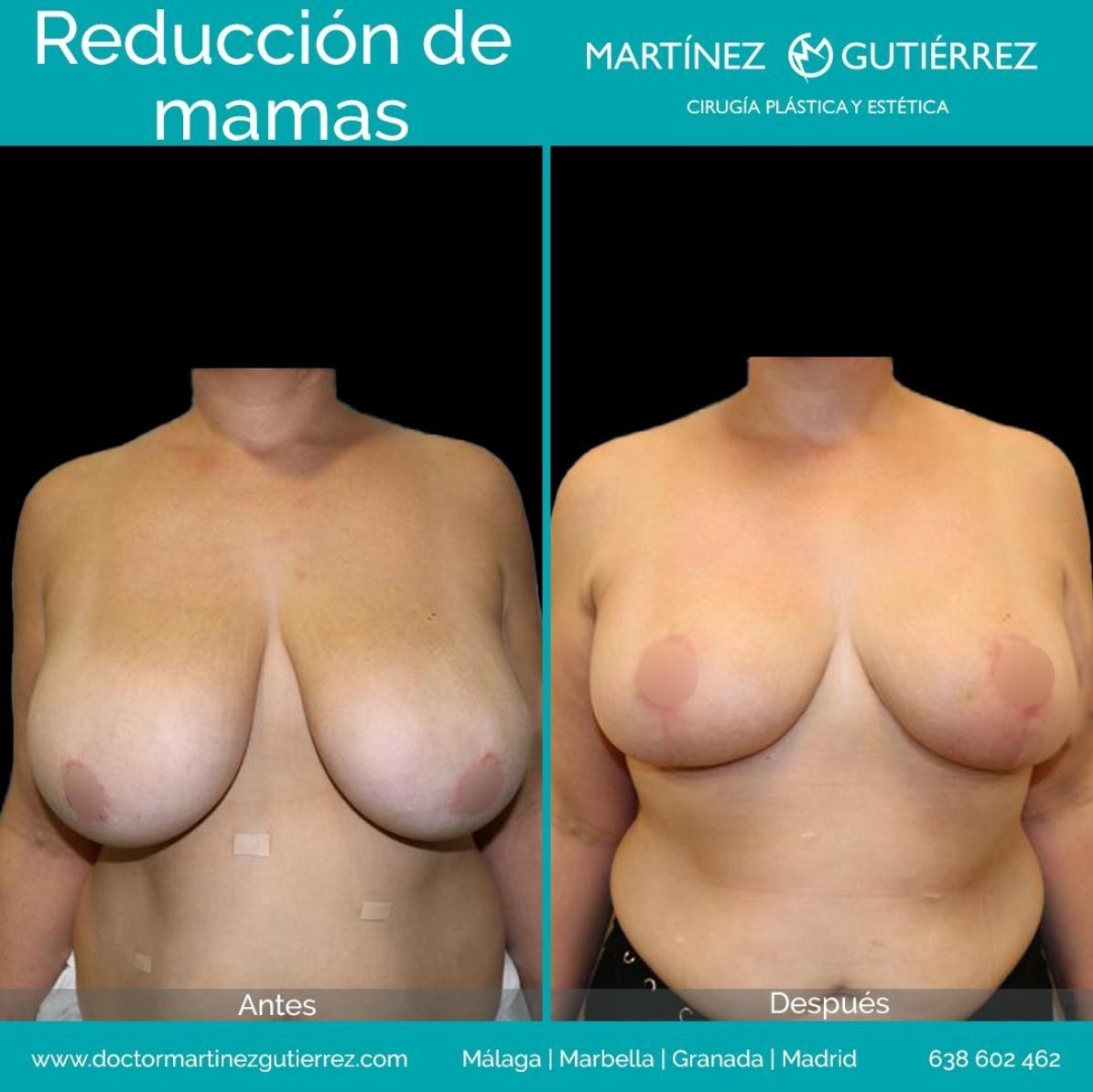 Reducción mamas resultado2